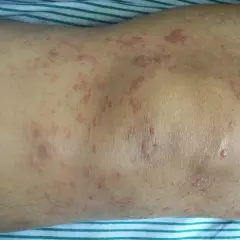 Hautveränderungen, die auf Mycosis fungoides hindeuten, zeigen sich als rote, schuppige Flecken und Plaques am Bein.