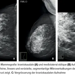 Mammografie-Aufnahmen zeigen feine, lineare Mikroverkalkungen in der Brust.