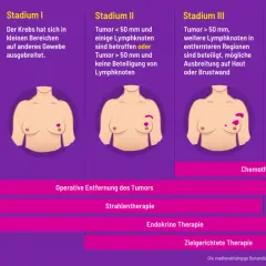 Brustkrebsstadien von 0 bis IV. Bei fortgeschrittenem aggressiver brustkrebs ist Chemotherapie eine Option.