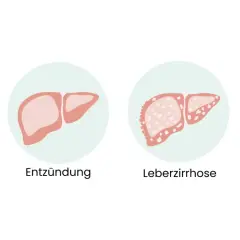 Illustration zeigt gesunde Leber, Entzündung, Leberzirrhose und Leberkrebs. Frühe Anzeichen von Leberkrebs sind oft unspezifisch.