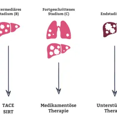 Illustration zeigt Leberstadien mit zunehmenden Metastasen. Stadium B: Leber mit wenigen Metastasen, Therapie TACE/SIRT. Stadium C: Lunge und Leber mit Metastasen, medikamentöse Therapie. Stadium D: Leber mit vielen Metastasen, unterstützende Therapie.