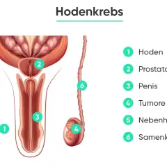 Anatomische Darstellung des männlichen Genitalbereichs mit Markierungen für Hoden, Prostata, Penis, Tumore, Nebenhoden und Samenleiter. Wichtige Informationen zur Hodenkrebs Therapie.