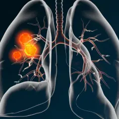 Darstellung von Lungenkrebs (NSCLC) mit leuchtend orangefarbenen Tumoren, die sich in den Bronchien ausbreiten. Medizinische Illustration.