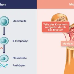 Erster Schritt der Therapie: gesunder Knochen vs. multiples Myelom. Myelomzellen schädigen Knochen und produzieren fehlerhafte Antikörper.