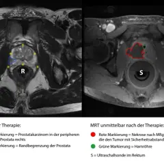 MRT-Aufnahmen zeigen metastasierten Prostatakrebs vor und nach Therapie. Links: Prostatakarzinom (blau) und Prostata-Rand (gelb). Rechts: Nekrose (rot) nach MRgFUS.