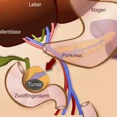 Anatomische Darstellung des Pankreas, Zwölffingerdarms und der Gallenblase mit einem Tumor. Zeigt den Bereich für eine partielle duodenopankreatektomie.