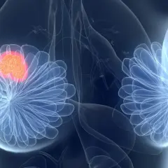 Brustkrebs-Tumor, der mit Ribociclib behandelt wird. Ribociclib ist eine Chemotherapie.