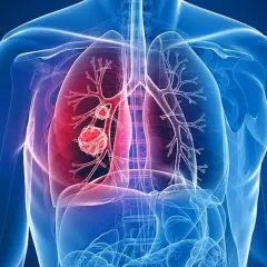 Menschliche Lunge mit einem roten Tumor, der Lungenkrebs darstellt. Das Alter spielt eine Rolle bei der Entstehung.