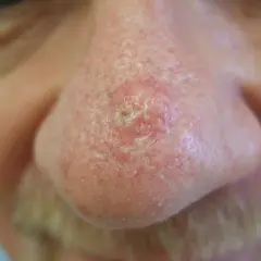 Nahaufnahme der Nase mit einem roten, schuppigen Bereich, der auf ein Basaliom hindeutet.
