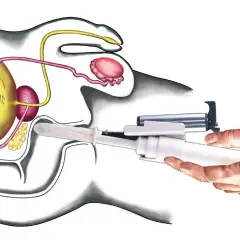 Illustration zeigt eine rektale Untersuchung mit einem Instrument, das in den After eingeführt wird, um die Prostata zu untersuchen.