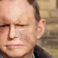 Ein Mann mit Narben im Gesicht, der die Hilfe eines Onkologen benötigt.