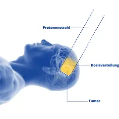 Protonenstrahltherapie zur Behandlung eines Hirntumors. Die Dosisverteilung zeigt, wie der Protonenstrahl den Tumor präzise trifft. Dies kann die Lebenserwartung bei Sarkomen verbessern.
