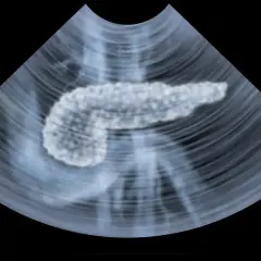 Ultraschallbild einer Bauchspeicheldrüse. Die Pankreas Untersuchung zeigt das Organ in detaillierter Ansicht.