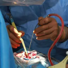 Chirurgen führen eine Hirntumor-OP durch. Hände mit Instrumenten arbeiten präzise am Gehirn.