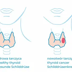 Vergleich von gesunder Schilddrüse und Schilddrüsenkrebs. Bei Krebs ist calcitonin erhöht, was auf eine Veränderung hinweist.