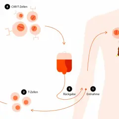 Schema zeigt, wie schnell wirkt Immuntherapie: T-Zellen werden entnommen, modifiziert (CAR-T-Zellen) und zurückgegeben, um Krebszellen zu bekämpfen.