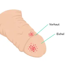 Illustration zeigt rote Flecken auf Vorhaut und Eichel, die auf mögliche peniskarzinom bilder hinweisen könnten.