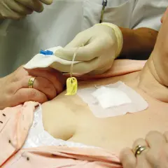 Eine Pflegekraft bereitet die **Port-Chemo**-Therapie vor. Ein Katheter wird an einen Venenport angeschlossen, um Medikamente zu verabreichen.
