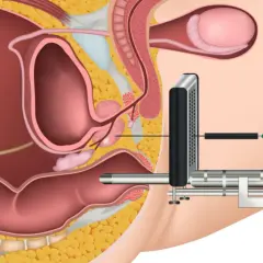 Darstellung einer MRT-gestützten Biopsie der Prostata. Ein Gerät wird in den Enddarm eingeführt, um die Prostata zu erreichen.