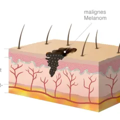 Querschnitt der Haut mit einem malignen Melanom, das sich in Oberhaut und Lederhaut ausbreitet. Haare und Blutgefäße sind sichtbar.