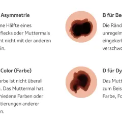 Hautveränderungen: Asymmetrie, unregelmässige Ränder, Farbwechsel und Dynamik sind Anzeichen für schwarzen Hautkrebs (Vorstufe).