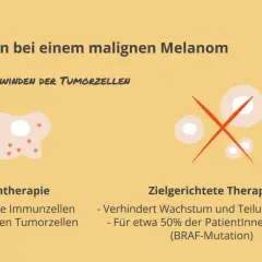 Illustrationen zeigen zwei Therapien gegen Melanom: Immuntherapie mit T-Zellen, die Tumorzellen angreifen, und zielgerichtete Therapie, die Zellwachstum stoppt.