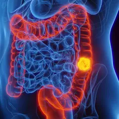 Darmkrebs-Tumor im menschlichen Darm, der eine wichtige Rolle bei der Erhaltungstherapie spielt.