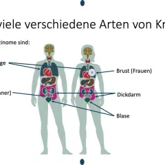 Abbildung zeigt, welche Krebsarten es gibt: Lunge, Prostata, Brust, Dickdarm und Blase sind häufige Karzinome.
