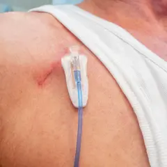 Port-a-Cath für Chemotherapie: Ein Blick auf die Haut mit dem Zugangssystem.