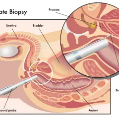 Illustration zeigt, was ist eine biopsie der Prostata. Eine Biopsienadel wird durch das Rektum eingeführt, um Gewebe zu entnehmen.
