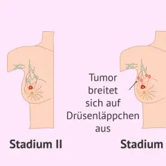 Illustrationen zeigen Stadien von Brustkrebs. Von Stadium I bis IV wächst der Tumor, befällt Lymphknoten und bildet Metastasen. Brustkrebs G3 Erfahrungen sind oft mit fortgeschrittenen Stadien verbunden.