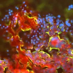 Mikroskopische Aufnahme von Zellen, die für die mikrometastasen behandlung relevant sind. Rote und gelbe Strukturen umgeben blaue Zellkerne.