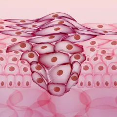 Abnormal cell growth, a concerning histologischer befund, shows invasive cells spreading through tissue layers.