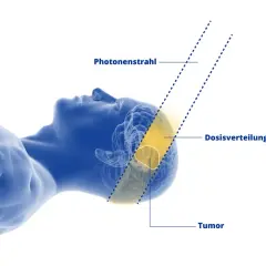 Illustration zeigt einen Kopf mit einem Hirntumor, der mit Photonenstrahlen behandelt wird. Die Dosisverteilung ist gelb markiert.
