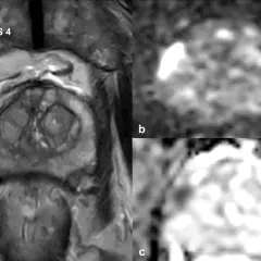 MRT Prostata Befund verstehen: Bild a zeigt eine Läsion mit PI-RADS 4. Bilder b und c zeigen die Diffusionsbildgebung, die bei der Interpretation hilft.