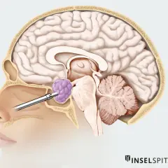 Chirurgischer Eingriff durch die Nase zur Entfernung eines Hypophysentumors.