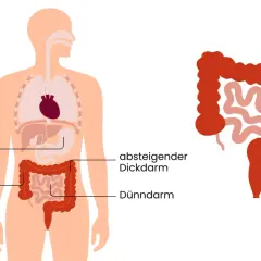 Illustration zeigt den menschlichen Verdauungstrakt mit einem hervorgehobenen Bereich, der Darmkrebs und Geschwüre im Dickdarm darstellt. Frühzeitige Erkennung von Darmkrebs Symptomen ist wichtig.