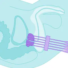 Illustration zeigt die Platzierung von Sonden für die Prostatakrebs-Strahlentherapie im Beckenbereich.