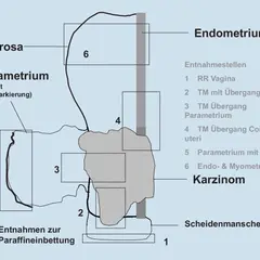 Schema zur Entnahme von Gewebeproben bei Zervixkarzinom. Markiert sind Serosa, Parametrium, Endometrium und Entnahmestellen.