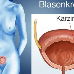 Illustration zeigt eine weibliche Figur mit einer Darstellung der Harnblase, in der ein Karzinom zu sehen ist. Dies illustriert das Urothelkarzinom der Harnblase.