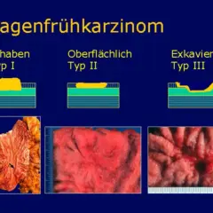 Magenkarzinom-Typen: Erhaben (Typ I), Oberflächlich (Typ II) und Exkaviert (Typ III). Bilder zeigen verschiedene Stadien eines pt2 tumor.