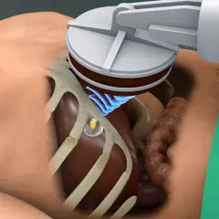 Ultraschallsonde über dem Bauchraum, ein kleiner, gelblicher tumor ultraschall erkennbar. Blaue Wellen zeigen die Schallübertragung.