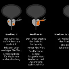 Illustrationen zeigen Stadien von Prostatakrebs, von Stadium I (unauffällig) bis Stadium IV (ausgebreitet), die die Entwicklung eines Adenokarzinoms der Prostata veranschaulichen.