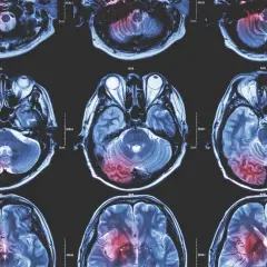 MRT-Aufnahmen zeigen Hirnbereiche mit abnormaler Aktivität, die auf einen Tumor hindeuten. Die roten Bereiche markieren die betroffenen Stellen.