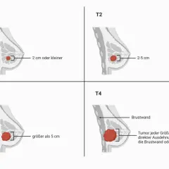 Veranschaulicht die **Mammakarzinom Stadien** T1 (kleiner als 2 cm), T2 (2-5 cm), T3 (größer als 5 cm) und T4 (Ausdehnung auf Brustwand/Haut).