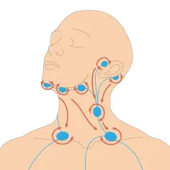 Illustration zeigt Lymphknoten im Halsbereich mit Pfeilen, die den Lymphfluss darstellen. Die Lymphknoten haben eine normale Größe.