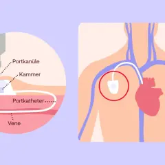 Schema zeigt ein medizinisches Portsystem: eine Nadel (Portkanüle) in der Kammer, verbunden mit einem Katheter in einer Vene. Das Port-System liegt nahe dem Herzen.
