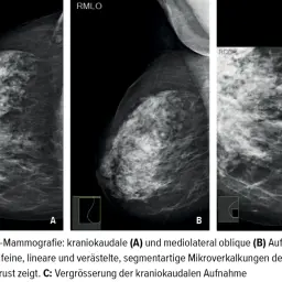 Mammografie-Aufnahmen zeigen feine, lineare Mikroverkalkungen in der Brust.