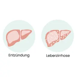 Illustration zeigt gesunde Leber, Entzündung, Leberzirrhose und Leberkrebs. Frühe Anzeichen von Leberkrebs sind oft unspezifisch.
