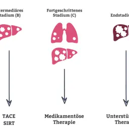 Illustration zeigt Leberstadien mit zunehmenden Metastasen. Stadium B: Leber mit wenigen Metastasen, Therapie TACE/SIRT. Stadium C: Lunge und Leber mit Metastasen, medikamentöse Therapie. Stadium D: Leber mit vielen Metastasen, unterstützende Therapie.